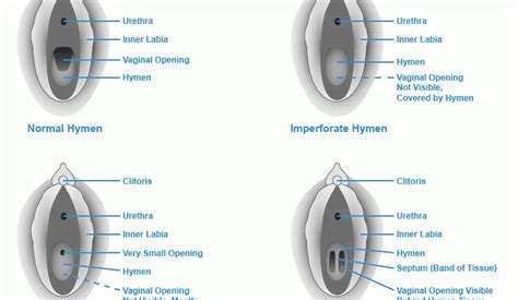 Hymen Appearance Functions Break Of The Hymen Healthy Food Near Me