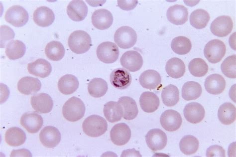Besplatna Slika Razmaz Krvi Stari Nezreo Schizont Plasmodium Malariae