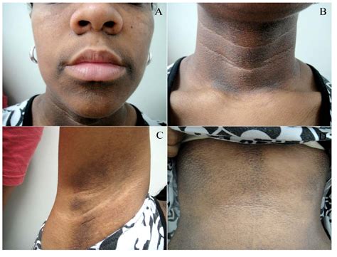 Acanthosis Nigricans Before And After