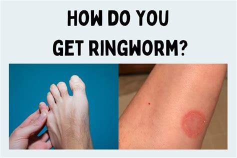 How To Get Rid Of Ringworm In Humans