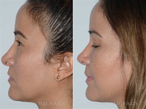 Fotos De Cirugía De Nariz Secundaria Revisiones Cirugía Facial Plástica Y Reconstructiva