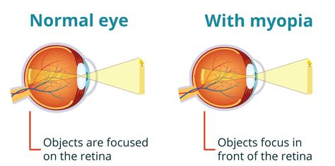 Myopia The Eye Practice
