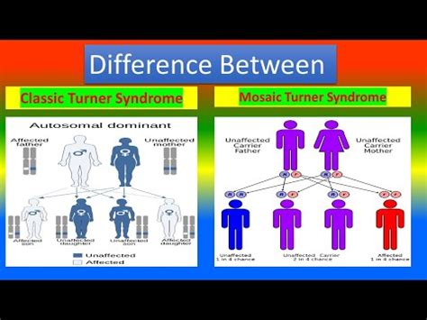 Classic Turner Syndrome And Mosaic Turner Syndrome YouTube