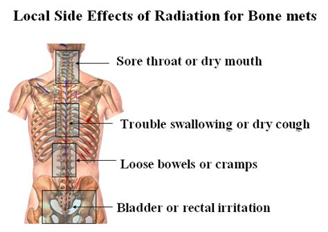 Side Effects Of Bone Marrow Cancer Cancerwalls