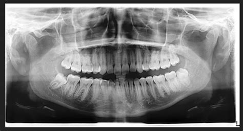 Impacted Wisdom Teeth Panoramic X Ray Teethwalls