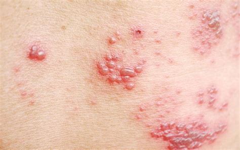What Are Shingles A Closer Look At The Reality Of Shingles The Healthy