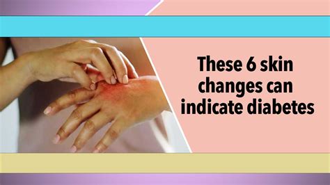 These Skin Changes Can Indicate Diabetes Lifestyle Times Of India Videos