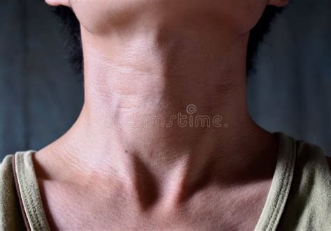 836 Thyroid Goiter Stock Photos Free And Royalty Free Stock Photos From