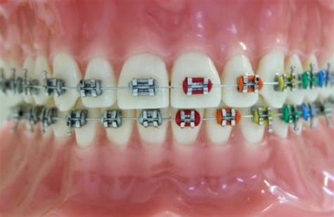 Types Of Ligation In Orthodontics Southern California Orthodontic