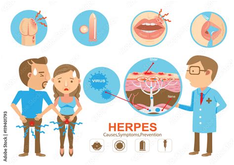 Vetor Do Stock Herpesdoctor Holding Diagram Herpes On The Lips And
