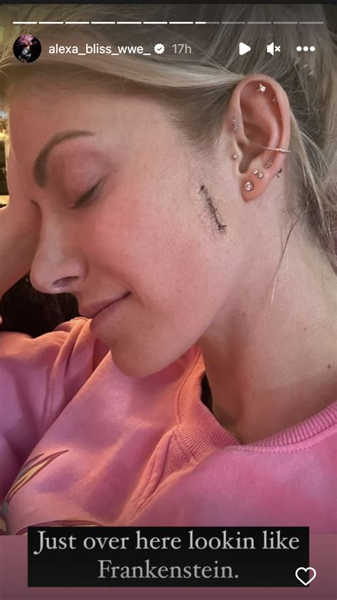 Wwes Alexa Bliss Shows Stitches From Cancer Surgery ‘lookin Like Frankenstein