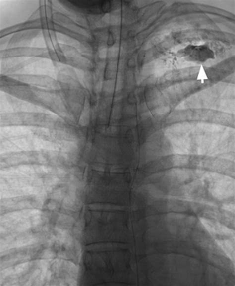 Thoracic Duct Embolization Of A Traumatic Chylous Leak Presenting With