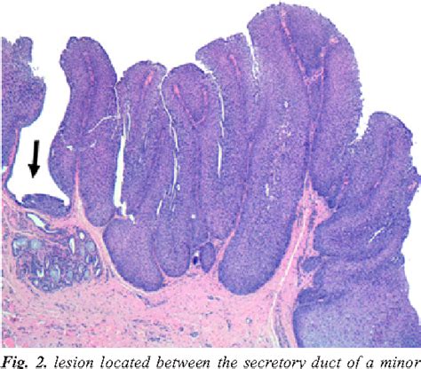 PDF Inverted Ductal Papilloma Of The Oral Cavity Secondary To Lower