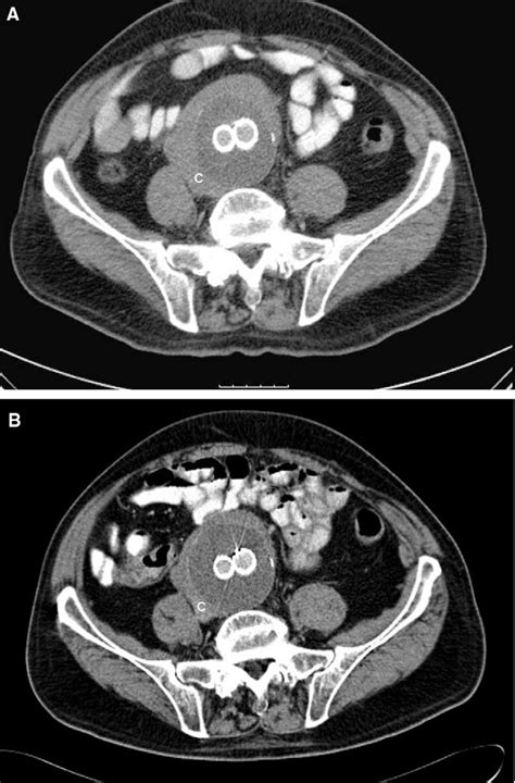 A Contrast Enhanced Ct Scan 14 Months Post Evar In A 76 Year Old Man