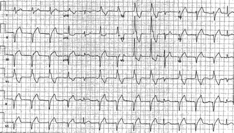 Accelerated Idioventricular Rhythm Wikidoc