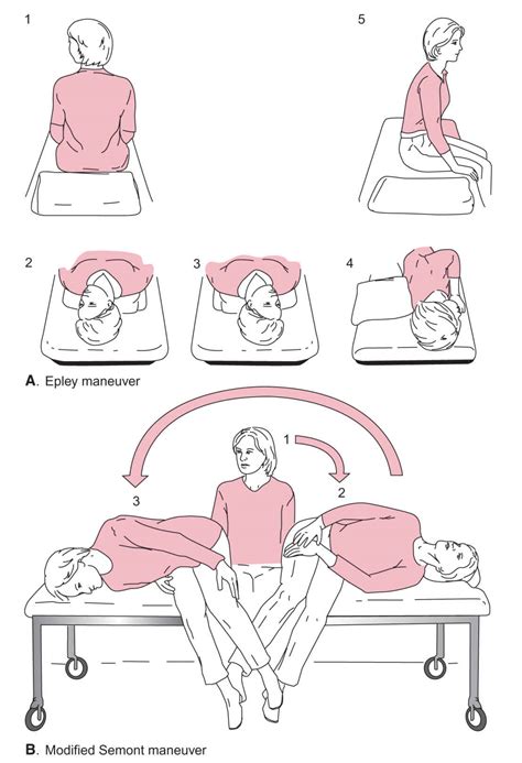 Stapedectomy Vertigo Physical Therapy Physicn