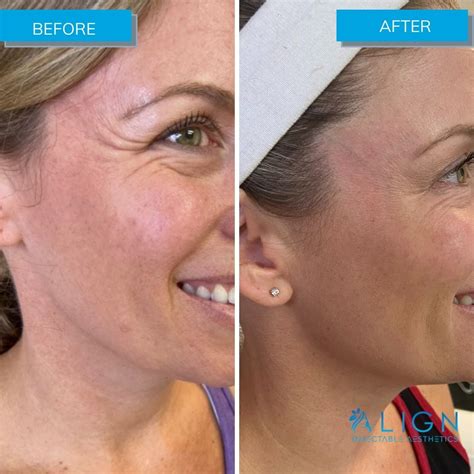 Before And After Botox® For Crows Feet Align Injectable Aesthetics