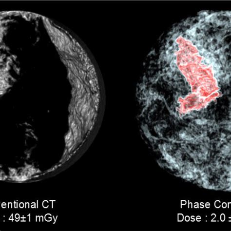 Comparison Between A Conventional Computed Tomography Ct Scan Of The