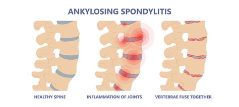 Avoid Disability Due To Ankylosing Spondylitis With Targeted Therapy
