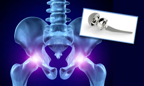 Investigating Complications Of Stryker Hip Replacements Clark Law Firm