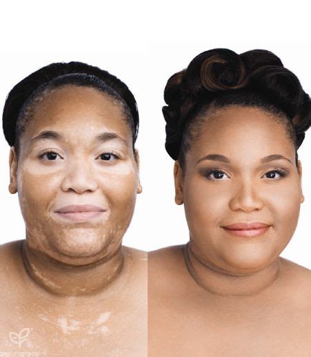 Before And After Jane Iredale Vitiligo Treatment Vitiligo Vitiligo
