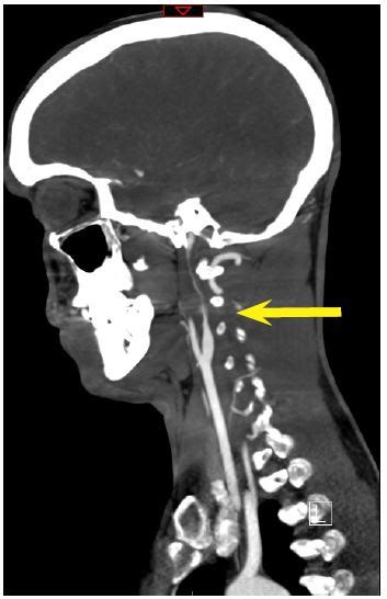 Cervical Artery Dissection And Choosing Appropriate Therapy The