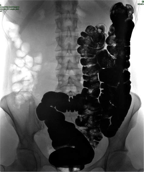 Double Contrast Barium Enema The Intestinal Malrotation With