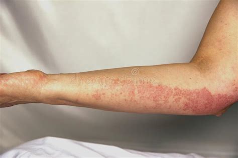 Allergic Rashes On The Arm Stock Photo Image Of Illness 154560138