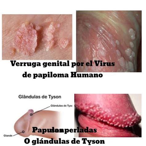 Imagenes Papiloma Humano Verrugas Genitales My Xxx Hot Girl