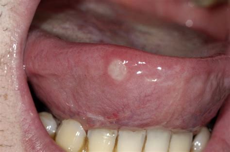 Canker Sores On Tongue