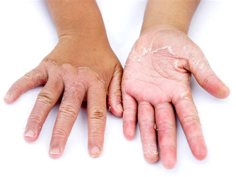 Ichthyosis Vulgaris Causes Symptoms And Diagnosis