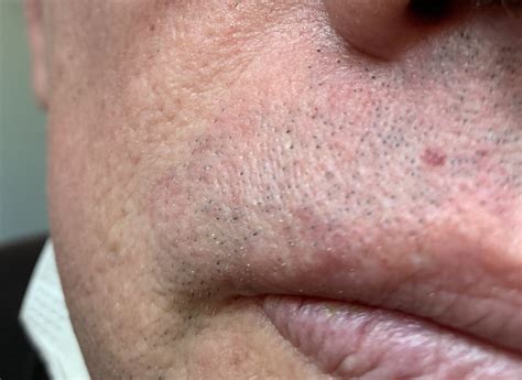 Five Red Spots On On The Face Skin