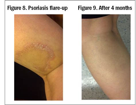 Psoriasis is more than just a skin condition… | Depke Wellness