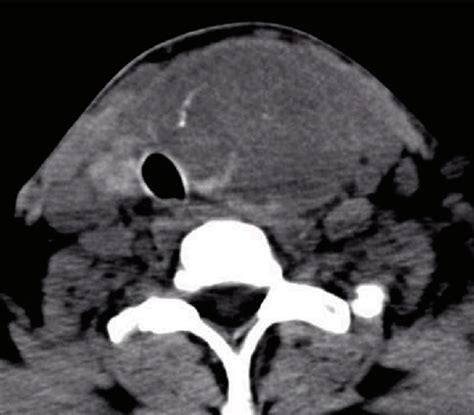 Neck Computed Tomography Scan Showing A Massively Enlarged
