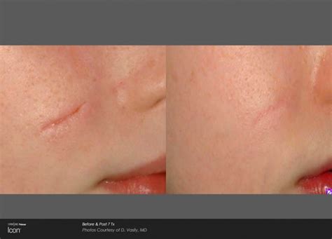 Laser Scar Removal Treatment In Perth Royal Indulgence Cosmetic