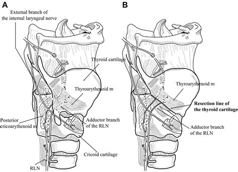 Novel Surgical Methods For Reconstruction Of The Recurrent Laryngeal