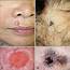 Clinical And Dermoscopic Photographs Of Squamous Cell Carcinoma 