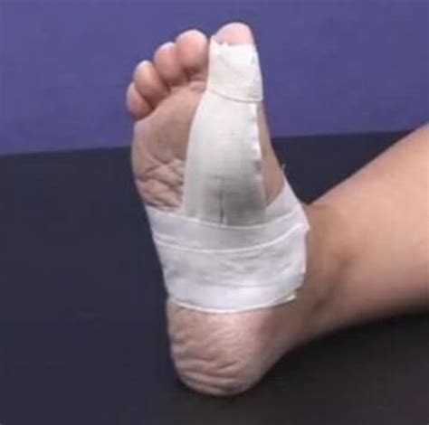 Turf toe is a painful injury to the base of the big toe that typically occurs in athletes who play field pro athletes often wear a shoe with a steel plate or have their athletic trainer tape the toe to keep it from. Turf Toe - Symptoms, Pictures and Treatment (Recovery)