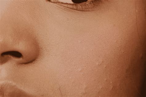 10 conseils pour en finir avec l'acné sur la peau noire ...