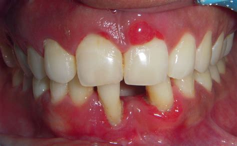 Baking soda mixed with 1/2 cup warm water and a pinch of salt. Treated Cases (Periodontal abscess) | Restore Dental ...