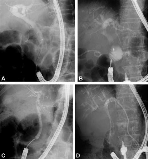 Outcomes Of Ercp In Billroth Ii Gastrectomy Patients Gastrointestinal