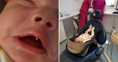 Mom Was Stunned After Her 11 Month Old Baby Grew A Fang Overnight