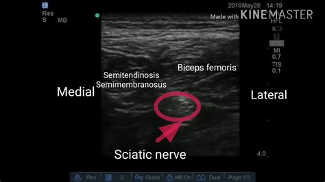 Classical snb and fnb require patient repositioning which can s. Ultrasound guided sciatic nerve block in the midthigh ...