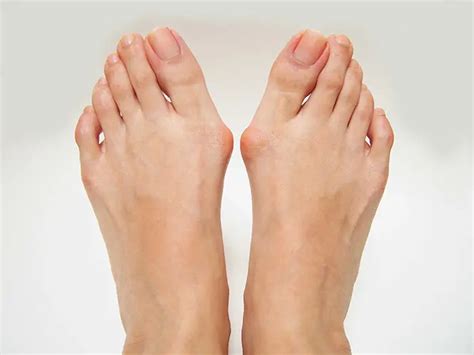 What Is A Bunion And How Do You Treat Them Profoot
