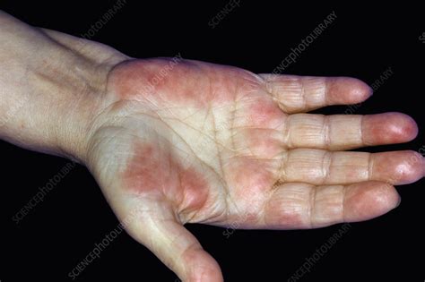 Neutrophilic Dermatosis In Sweets Disease Stock Image C0486273