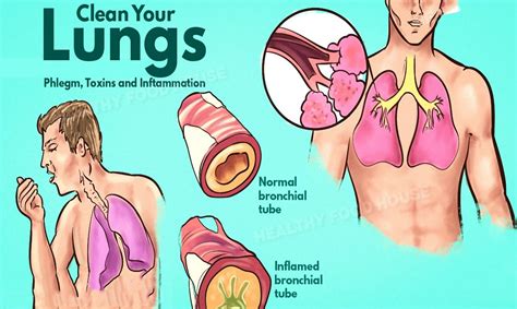 How To Get Rid Of Phlegm And Mucus In Chest Throat Instant Result