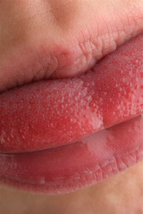 Swollen Taste Buds Causes Diagnosis And Treatment