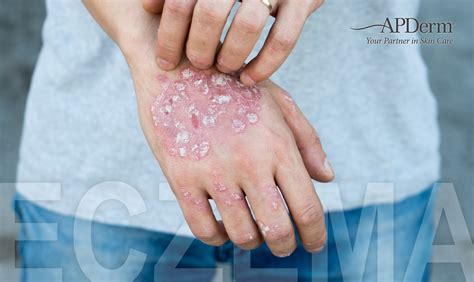Eczema Causes Symptoms Treatments How To Get Rid Of Eczema Ph