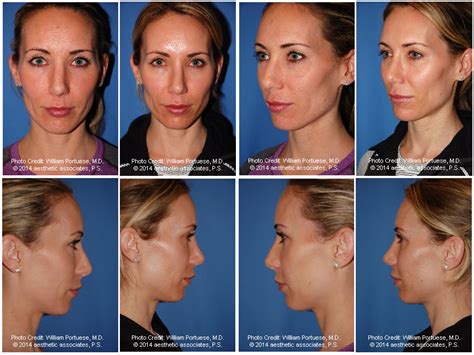Asymmetrical Nose Before And After Photo Gallery Nose Surgery Photos