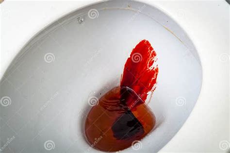 Splattered Blood In A Toilet Bowl Representing A Bloody Stool A Sign
